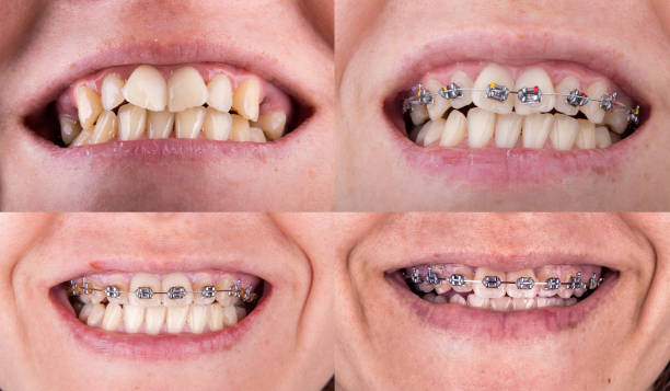 Teeth Braces Before and After