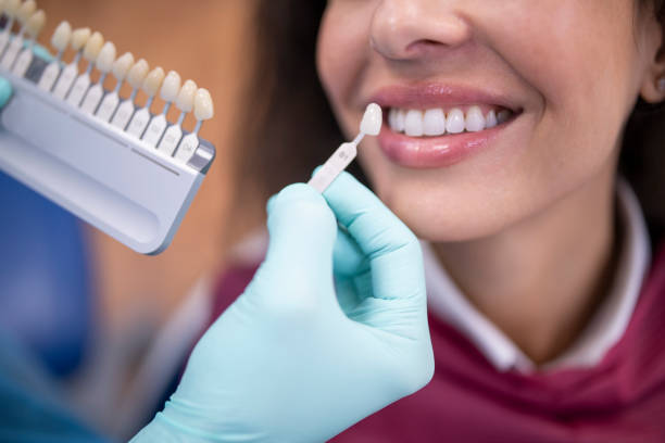 Tooth Whitening Treatment in Nizampet