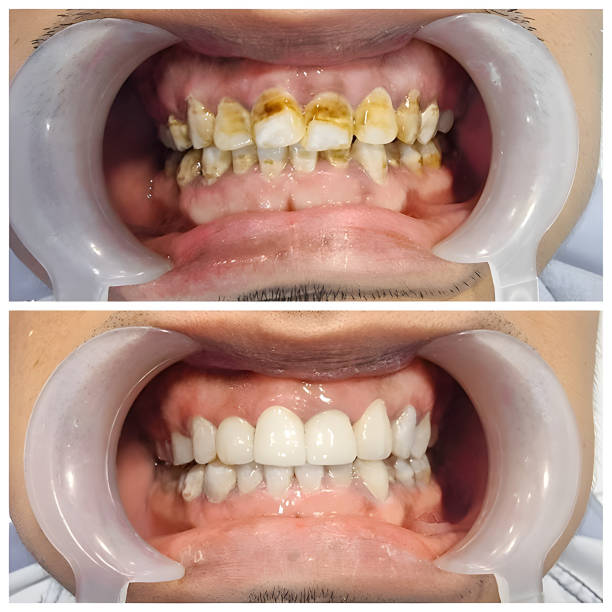 Teeth Whitening in Hyderabad