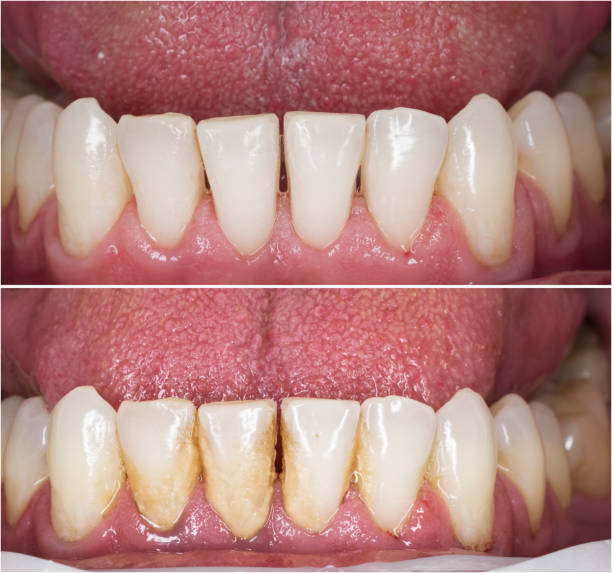 Teeth Whitening in Hyderabad