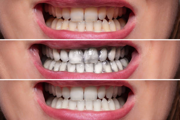 Tooth Whitening Treatment in Nizampet