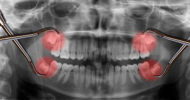 Wisdom Tooth Removal in Nizampet