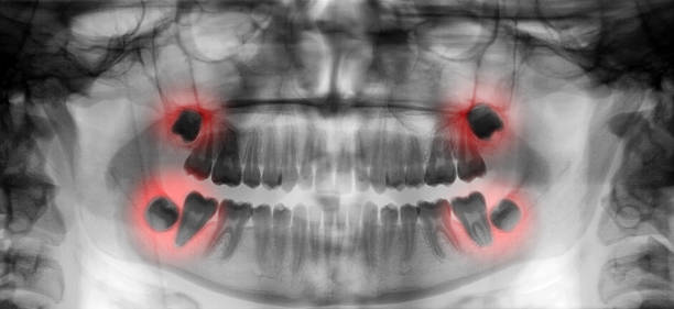 Wisdom Tooth Removal in Hyderabad
