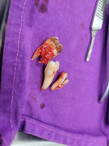 Wisdom Tooth Removal in Nizampet