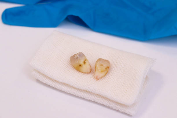 Wisdom Tooth Removal in Hyderabad