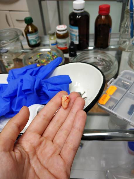 Wisdom Tooth Removal in Hyderabad