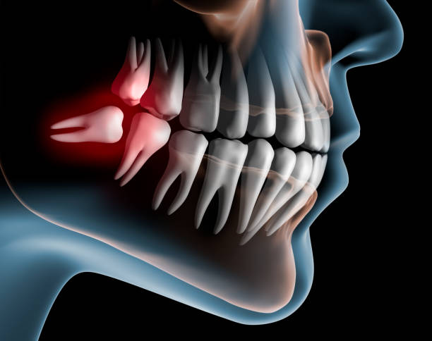 Wisdom Tooth Removal in Nizampet
