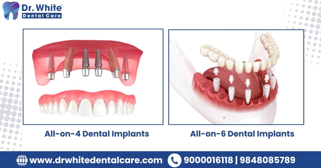 Types Of Full Mouth Dental Implants