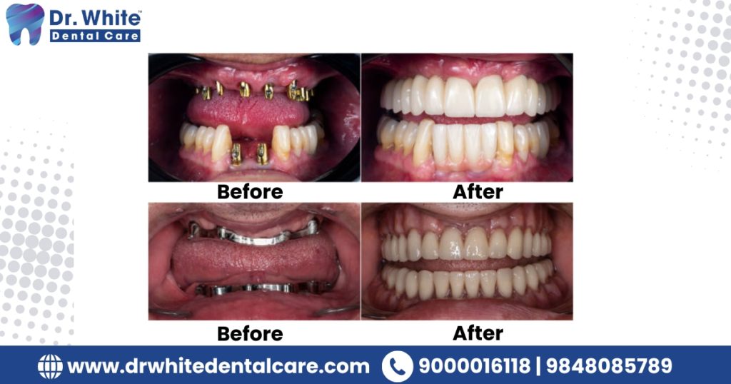 Full Mouth Dental Implants Cost
