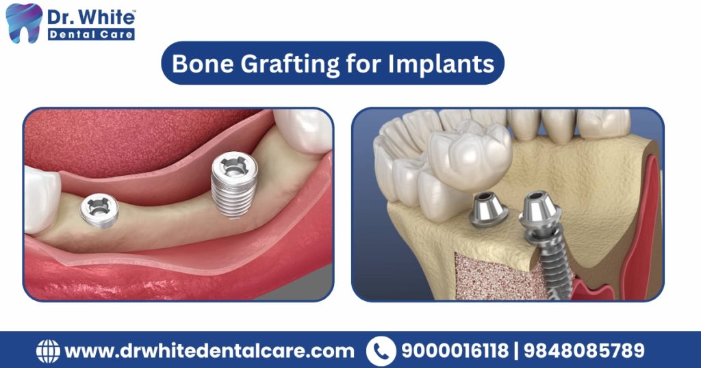 Bone Grafting for Implants