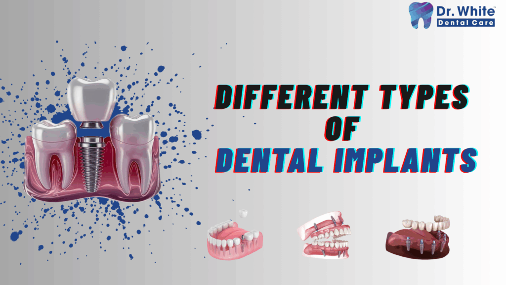 Different Types of Dental Implants