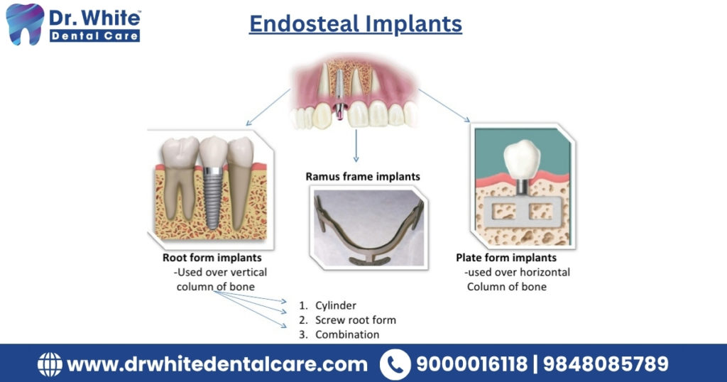 Endosteal Implants