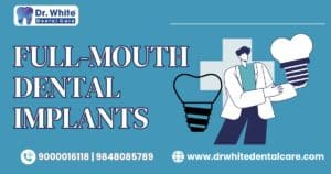 Full Mouth Dental Implants