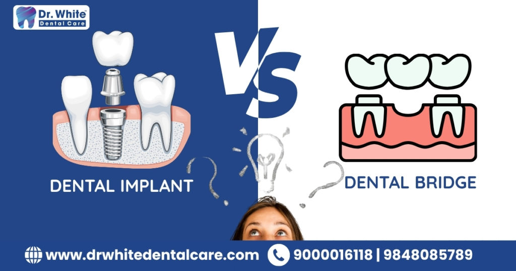 Tooth Implant vs Dental Bridge