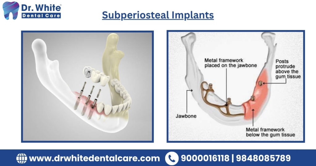 Subperiosteal Implants