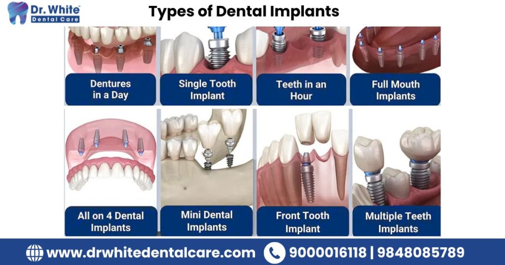 Types of Dental Implants