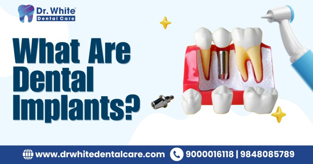 What Are Dental Implants?