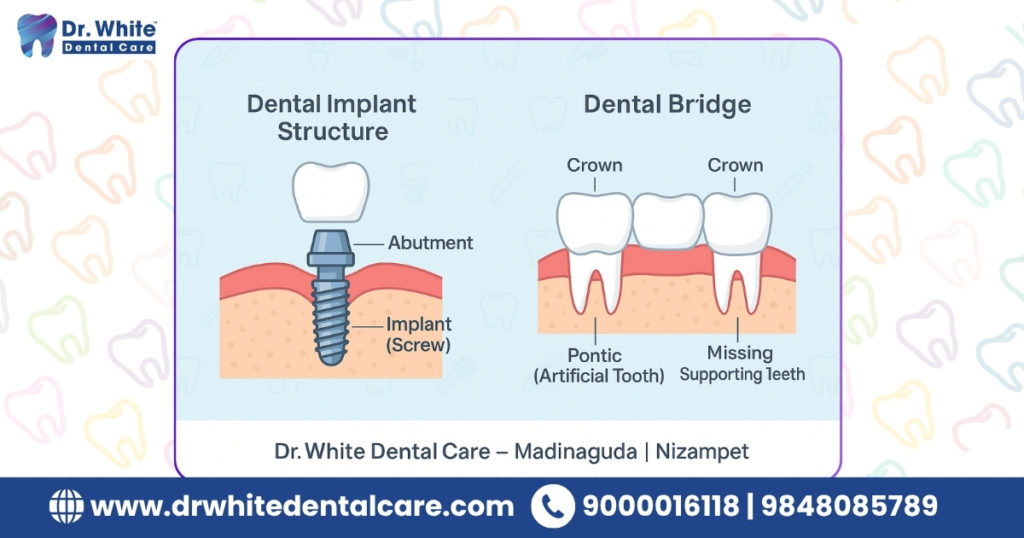 What Is a Tooth Implant?
