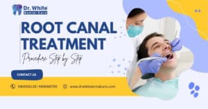 Root Canal Treatment Procedure Step by Step