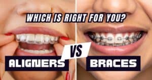 Invisalign vs Braces