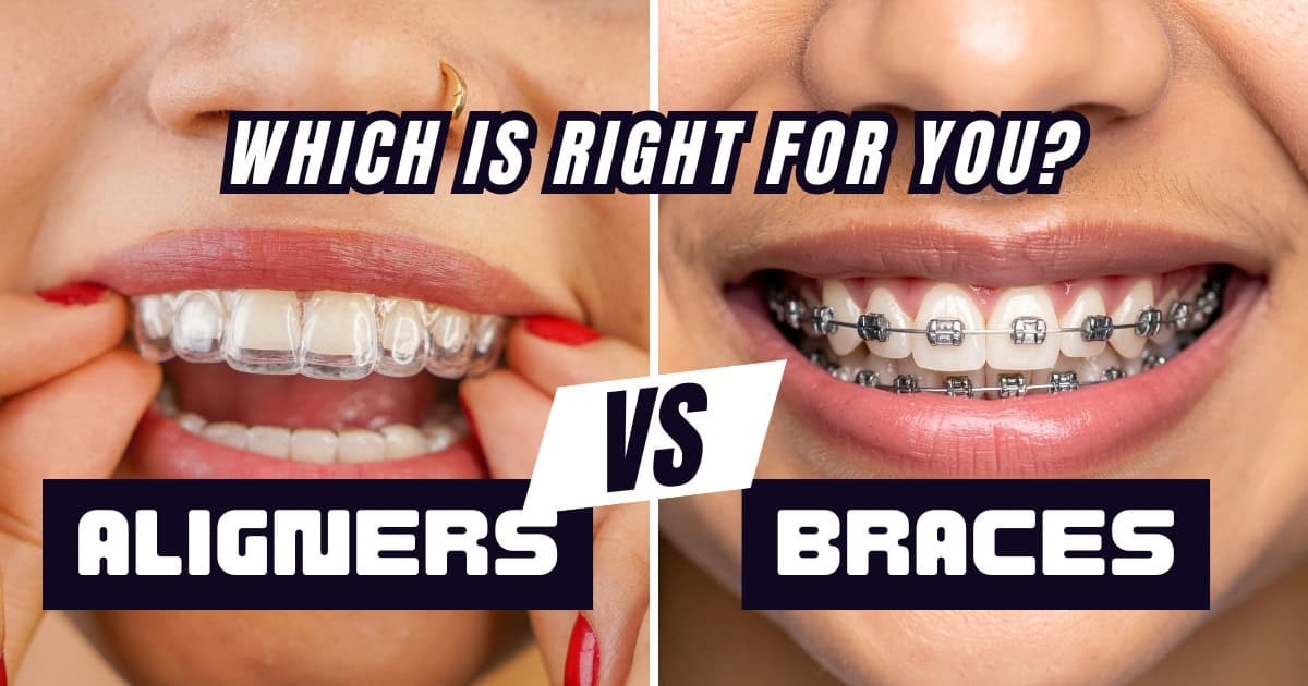 Invisalign vs Braces