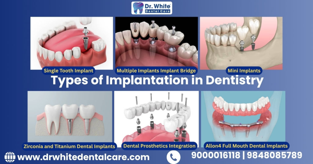 Types of Implantation in Dentistry