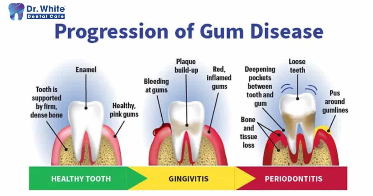 Healthy gums and teeth supporting strong enamel; warning signs of gum disease progression.