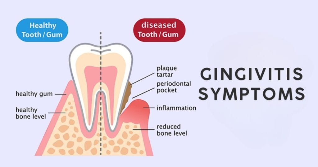 Gingivitis Symptoms