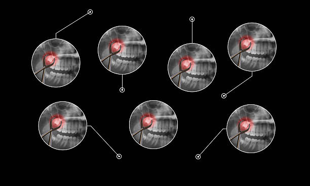 Signs to Need Wisdom Tooth Removal