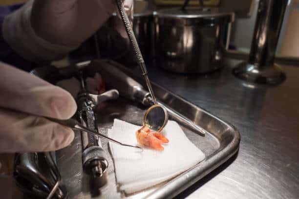 Why Are Wisdom Teeth Removed?