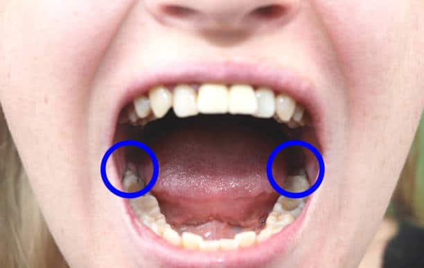 Signs You Need Wisdom Tooth Removal