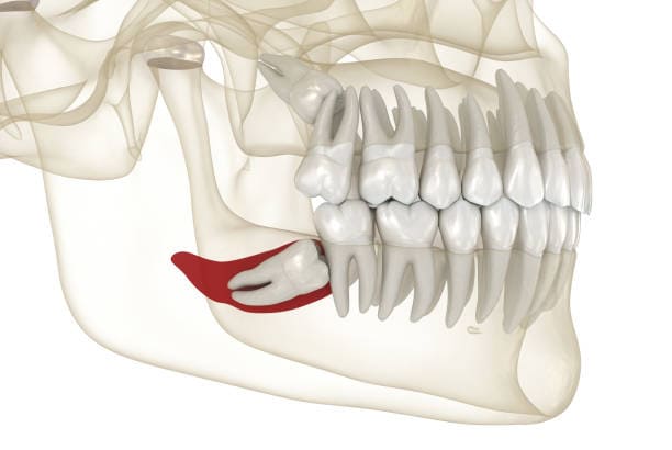 Best Wisdom Tooth Care in Madinaguda