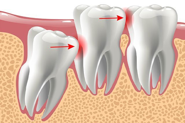 Why Choose Dr. White Dental Care for Wisdom Tooth Removal