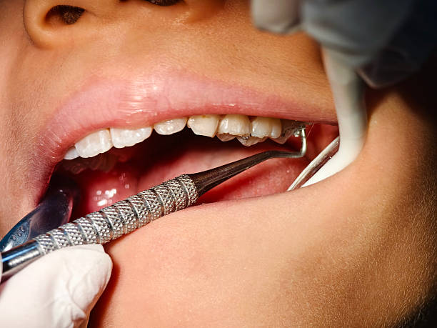 Dental Fillings in Madinaguda