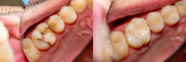 Cavity treatment and dental fillings at Dr. White Dental Care.