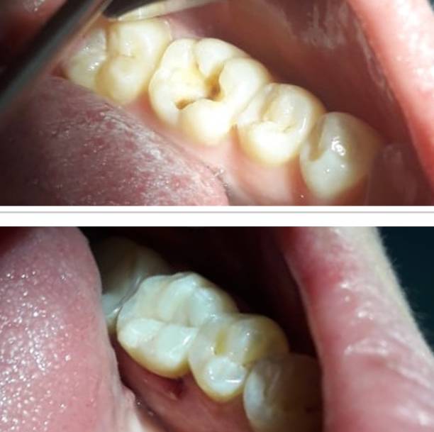 Dental Fillings in Nizampet