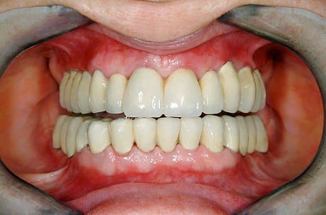 SameDayDentalRestoration, patient’s healthy teeth after dental crowns, expert dental care service.