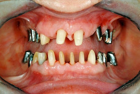 Severely damaged teeth with dental implants and missing teeth restoration.