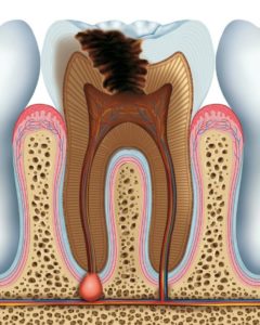 Root Canal Treatment in Hyderabad