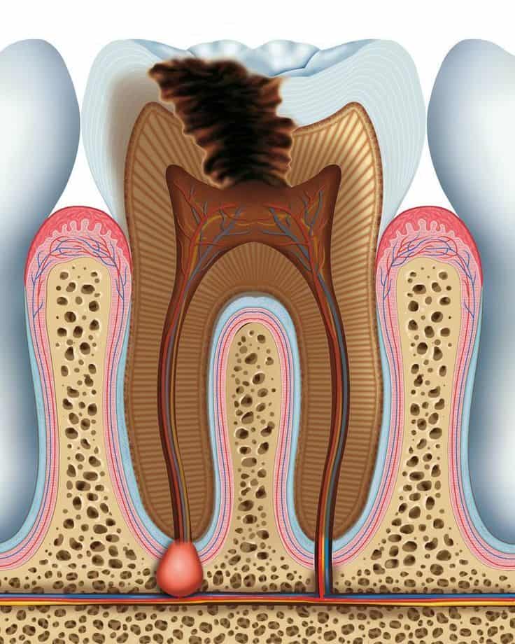 Root Canal Treatment in Hyderabad