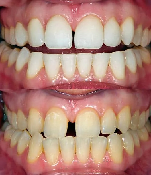 Teeth Braces Before and After