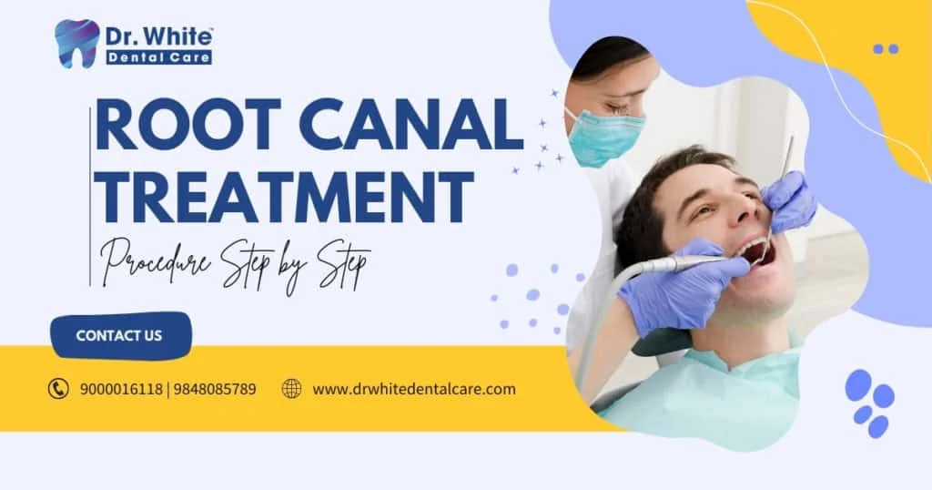 Root Canal Treatment Procedure Step by Step